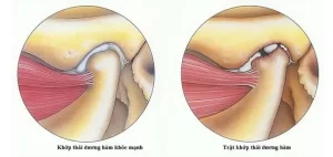 VIÊM KHỚP THÁI DƯƠNG HÀM: NGUYÊN NHÂN, DẤU HIỆU & CÁCH TRỊ