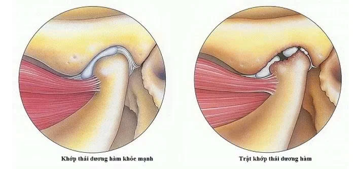 VIÊM KHỚP THÁI DƯƠNG HÀM: NGUYÊN NHÂN, DẤU HIỆU & CÁCH TRỊ